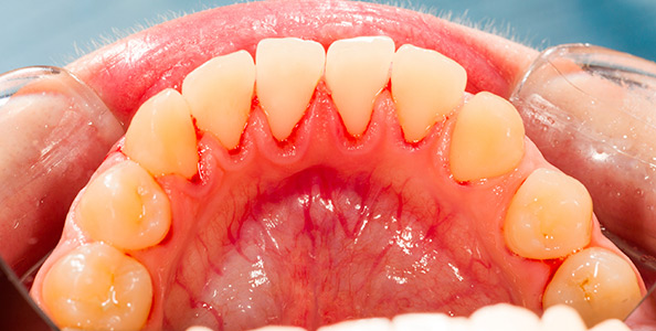 Ömt blödande tandkött och andra tandköttsproblem