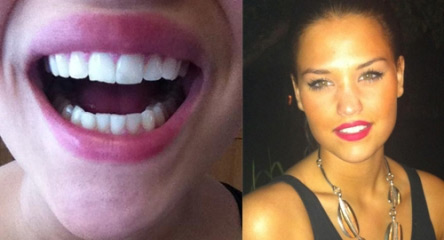 Magdalena Reise blekte tänderna med Dentaworks