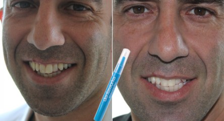 Dentaworks tandblekningspenna