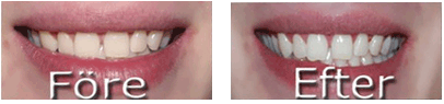 Vita tänder bilder före och efter