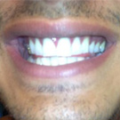 "Tänderna blev nästan för vita"